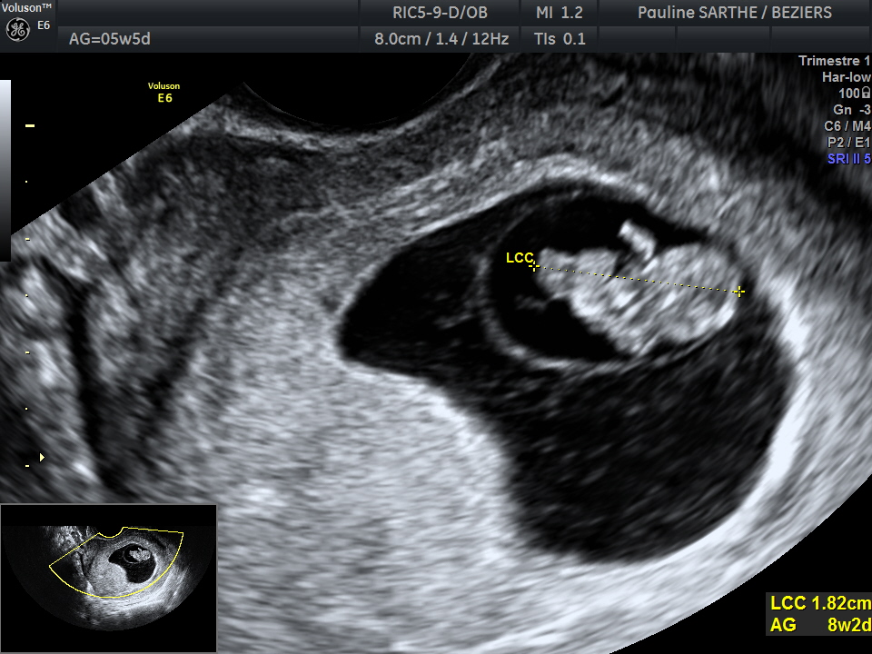 Echographie, un examen indolore et sans danger pendant la grossesse